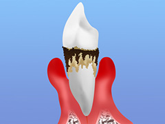 むし歯・歯周病は全身に悪影響をおよぼします